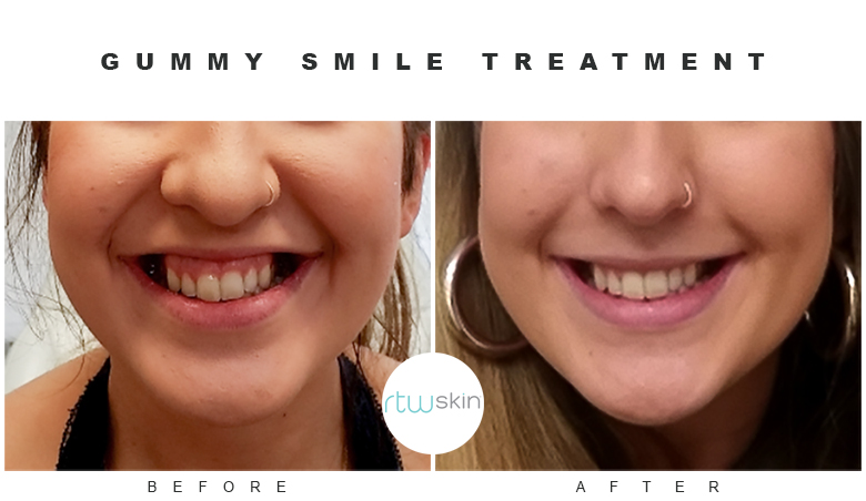 Gummy Smile Before and After